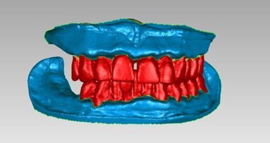 Precisie, efficiëntie en voorspelbaarheid met de Digitale AvaDent-immediaatprothese