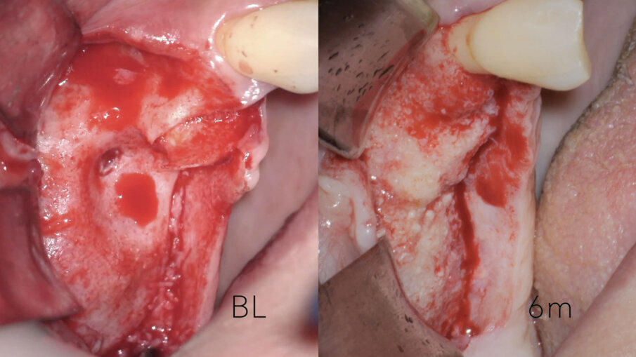 Fig. 11 - Rientro chirurgico a 6 mesi.