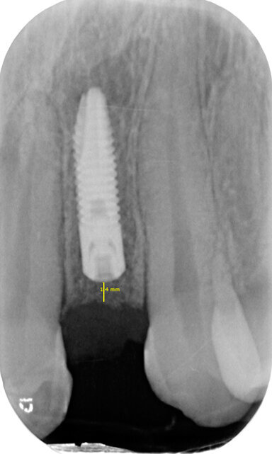 Fig. 4b - Rx endorale post-operatoria impianto sede 22.