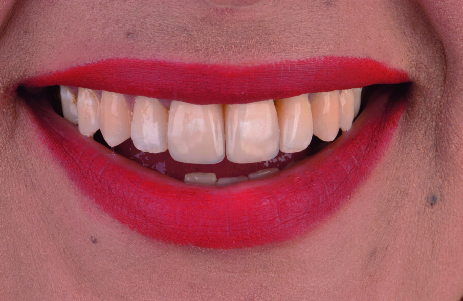 Fig 1b. After smile rejuvenation with BioSmart restorative materials