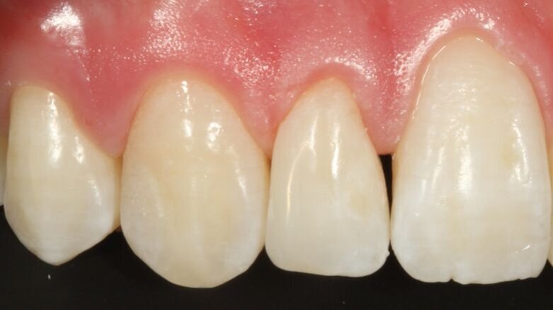 Eén composiet, één kleur voor alles?