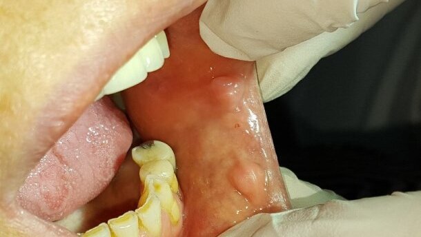 Zastosowanie lasera CO2 w leczeniu zmian na błonie śluzowej – opis przypadków