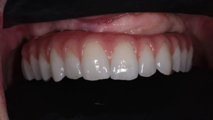 Obr. 12a, b: Intraorální snímek (a) a periapikální RTG snímek (b) definitivní náhrady.