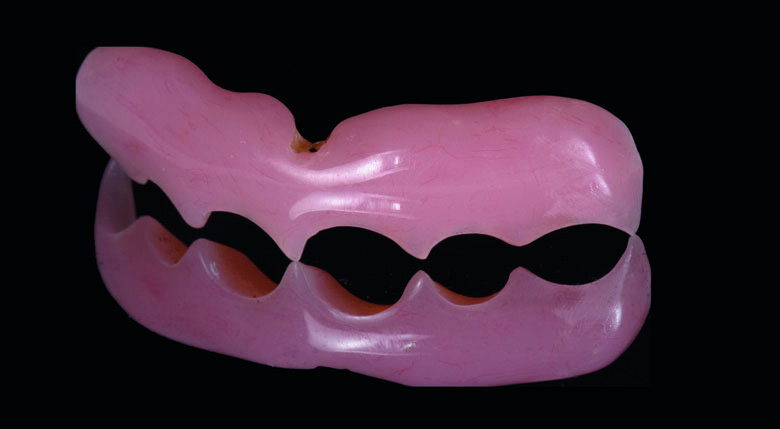 Fig 3. Acrylic Gingival Veneer. AGV