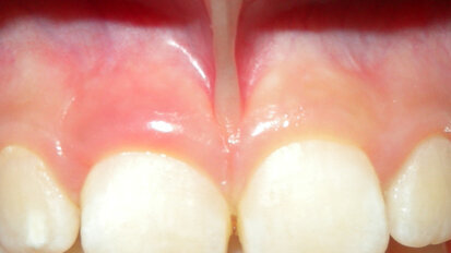 Frenulectomia Laser Nd:Yap gold standard della chirurgia orale pediatrica: a case report