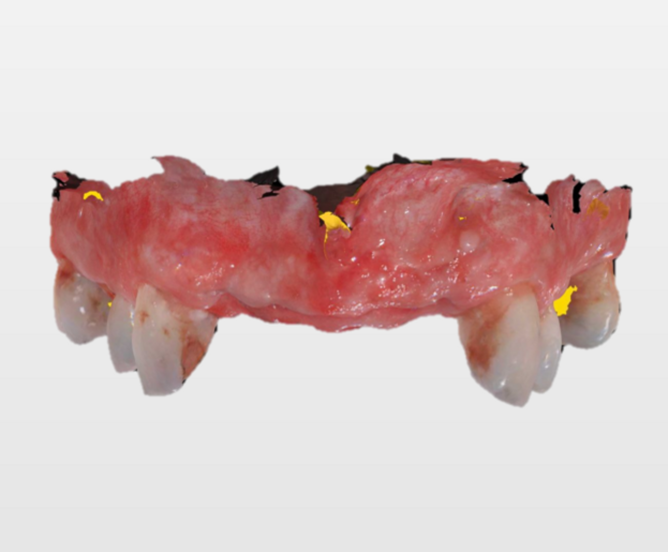 Figs. 8a & b: Digital impressions after the extractions.