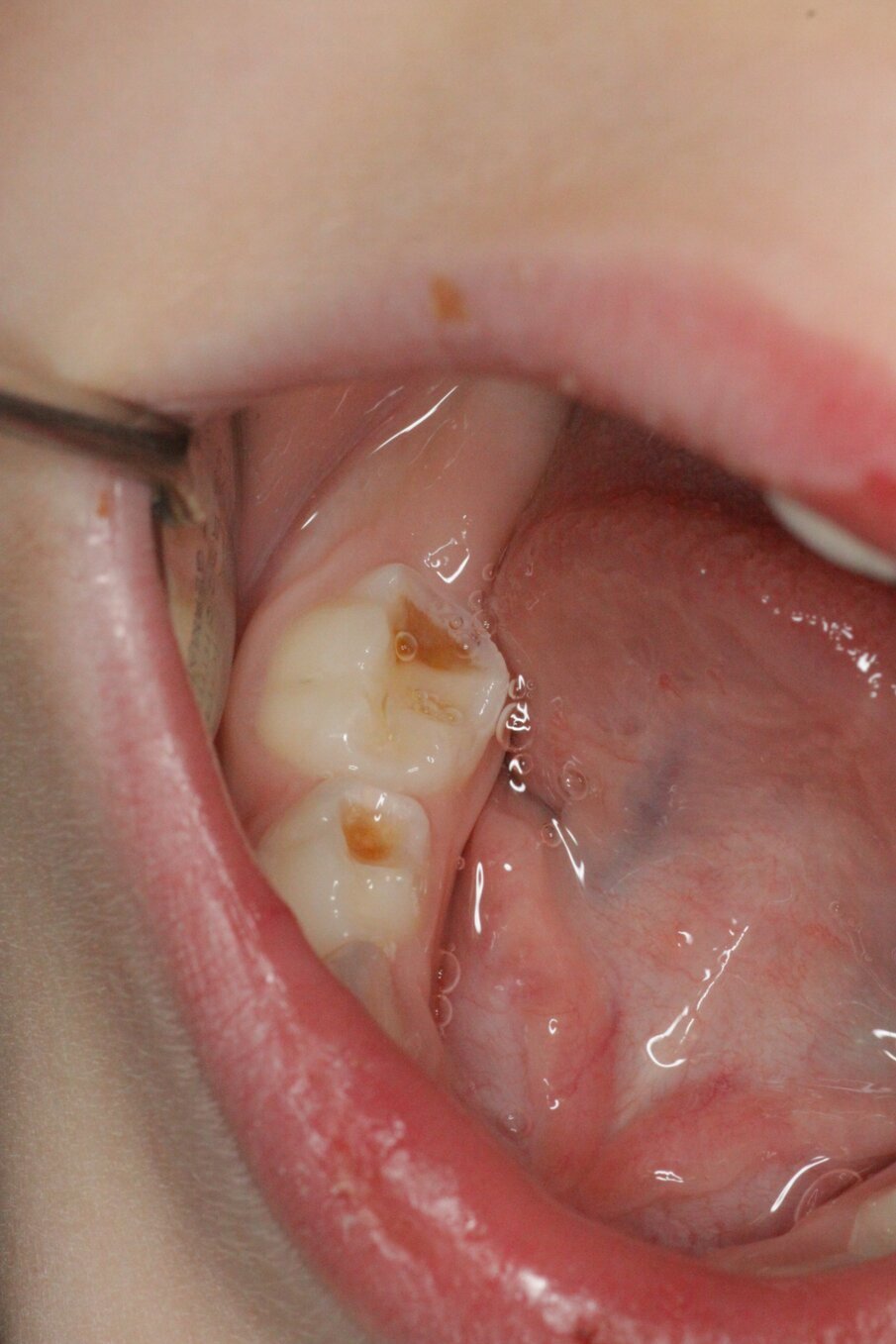 Afbeelding 3b. Cariëslaesies ruim half jaar later stabiel. 