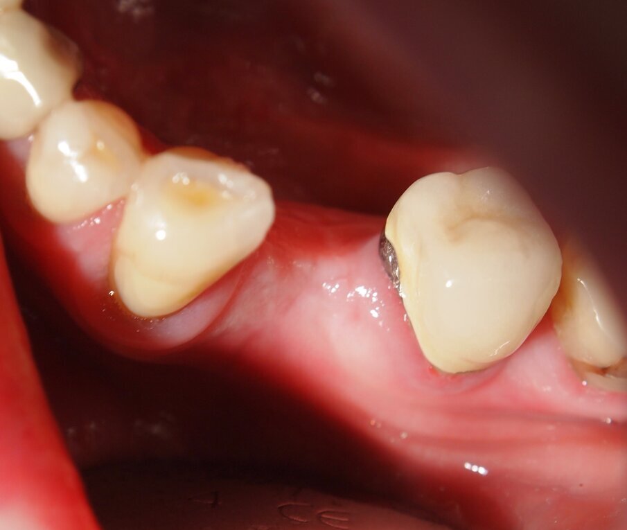Fig. 2 - Caso clinico 1. Visione preoperatoria: sito 34 edentulo. 