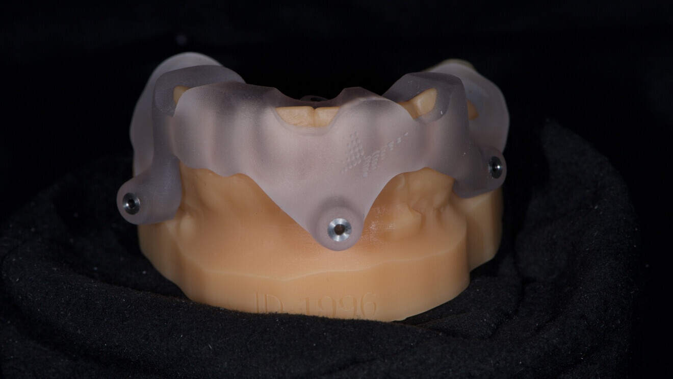 Fig. 6: Surgical guide without metallic sleeves for preparation of the pin sites.