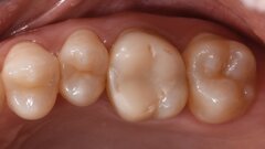 A biomimetic approach to restoration after endodontic treatment
