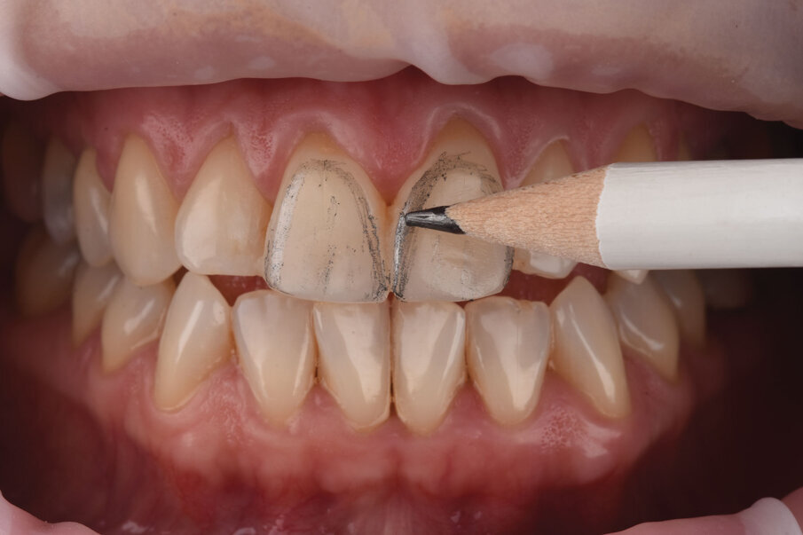 Sl. 13: Završna obrada i poliranje restauracije