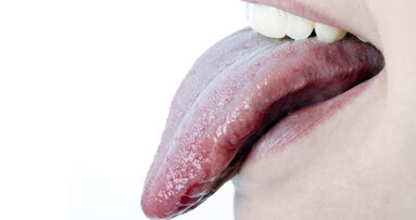 Speicheltest könnte Diagnostik verbessern