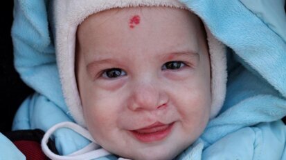 LCMD spreads awareness on Craniosynostosis and Distraction Osteogenesis