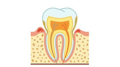Parodontitis verhoogt risico op beroerte bij mensen onder de 50