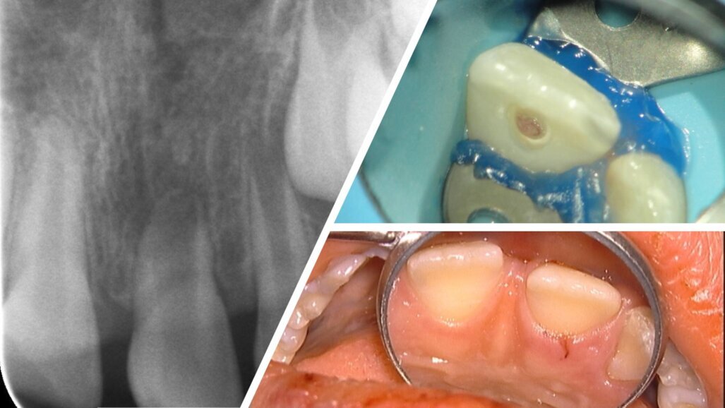 Gezocht voor onderzoek: kinderen met tandschade