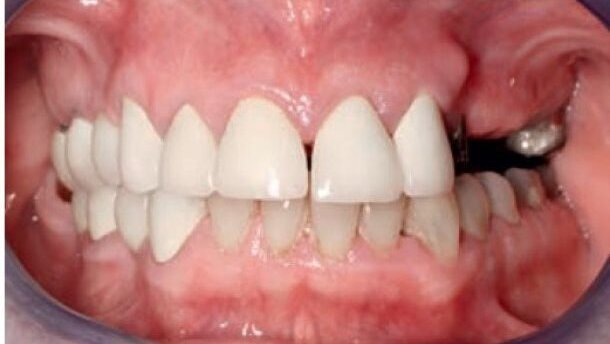 Konstrukcja mostu w odcinku przednim żuchwy