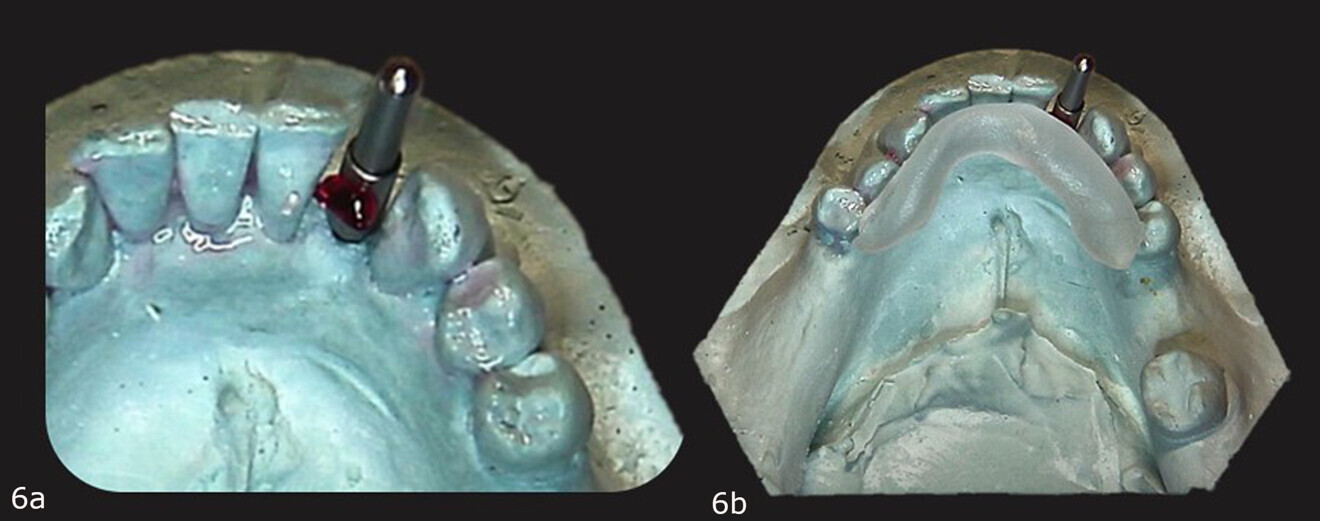 Figs. 6a & b: Primopattern LC Gel placed over the cleat (a). Primosplint placed on the lingual aspect of the teeth on the cast (b).