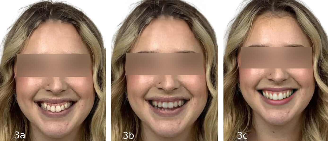 Figs. 3a–c: ligner simulation software from Angel Aligner: before (a), and after simulation (b) compared with Smile Geni after treatment simulation (c).