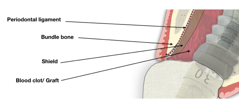 Udatta Kher socket shield 2