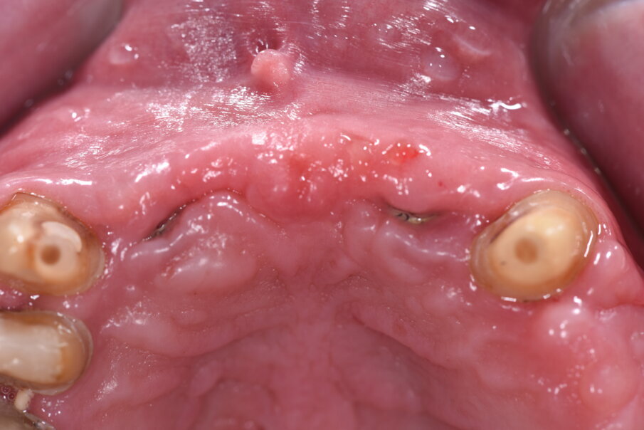 Fig. 24_Dopo 4 mesi abbiamo rimosso il provvisorio per capire come si era conformato il tessuto gengivale al di sotto dello stesso. Dopo altri due mesi abbiamo provveduto a opercolarizzare usando un diatermocoagulatore.