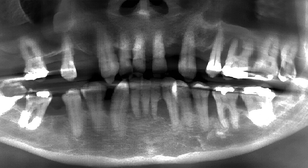 Fig. 2a: Pre-op panoramic radiograph showing extensive bone loss.