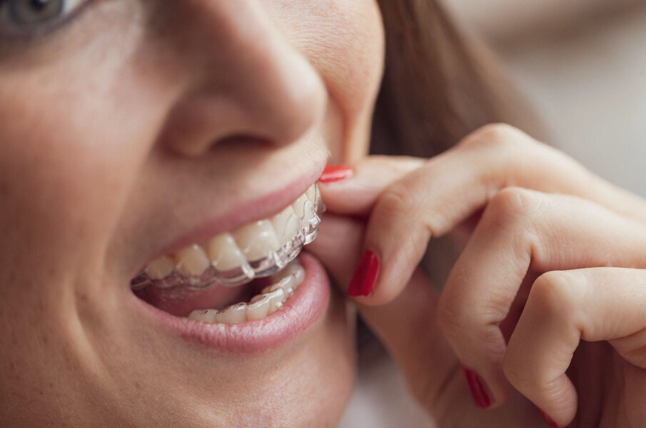 Aligneurs dentaire Cheeez