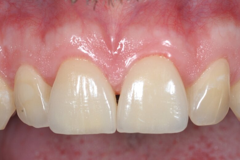 Fig. 26 Two months post-op.