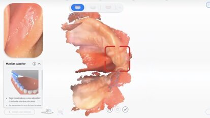 Labio y paladar fisurado Luna Video3