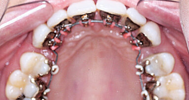 Řešení bimaxilární protruze extrakcemi a lingválním aparátem