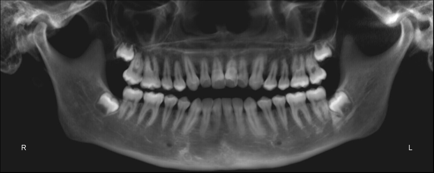 Fig. 3: Pretreatment panoramic radiograph.