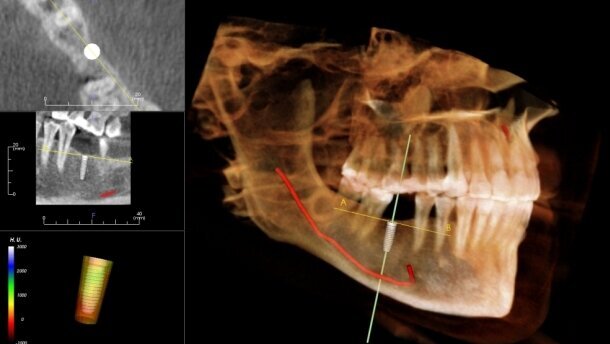 InVivo Dental – doskonała diagnostyka w implantologii