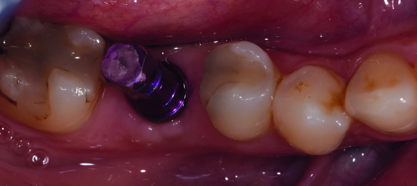 Fig. 16 : Mise en place du transfert d’implant à ciel fermé. 