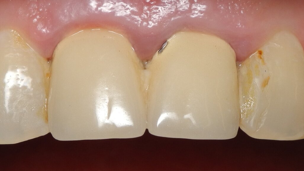 Same-day dentistry: Replacement of two PFM crowns with zirconia restorations