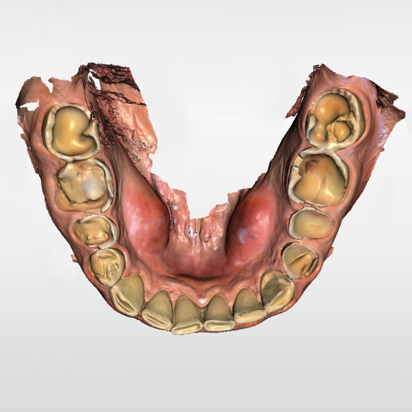 Fig. 3b: Digital scan of the initial situation. Lower jaw.