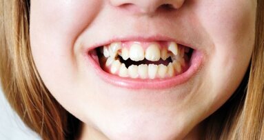 Landbouw zorgde voor scheve tanden