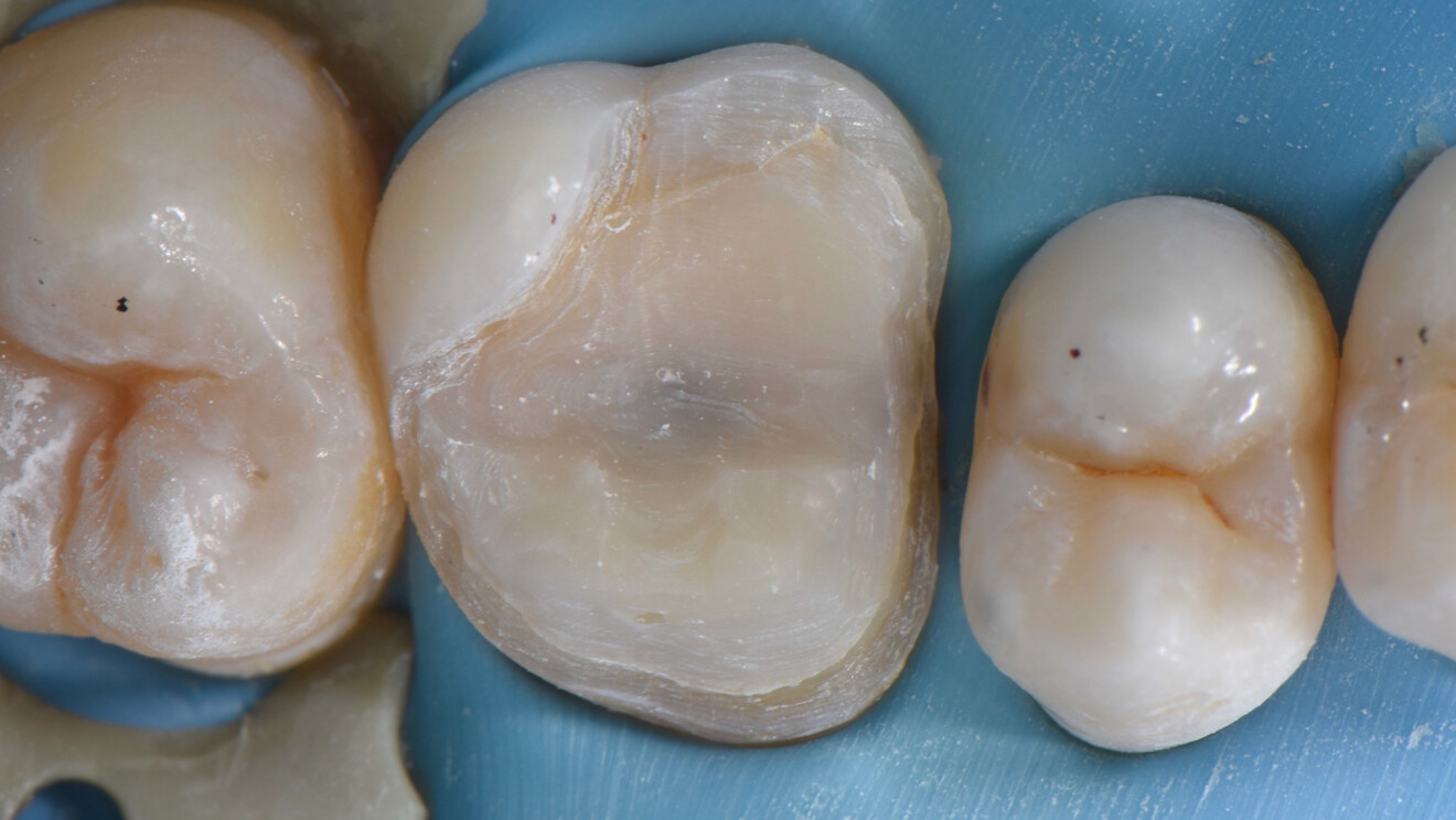Fig. 5: Completed onlay preparation. Gaps and white lines beneath the composite restoration indicated debonding of the composite.