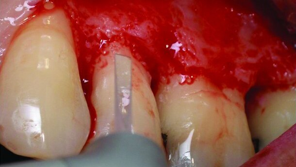 Utilisation du laser Er:YAG pour la chirurgie parodontale assistée par laser