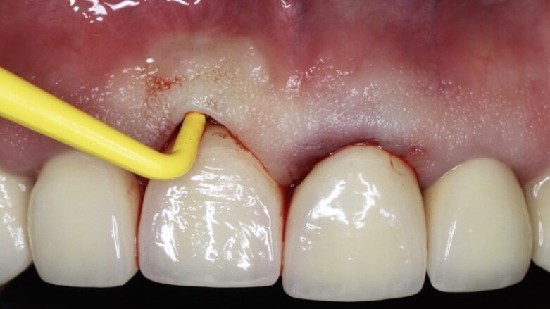 Importante Curso sobre Medicina Periimplantar