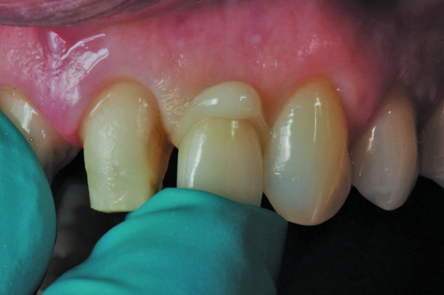 Fig. 15: The crown is firmly seated under finger pressure and the excess removed with a scaler after a 1-2 second tack cure. Final cure for 20 seconds per surface. Finish and polish as needed.