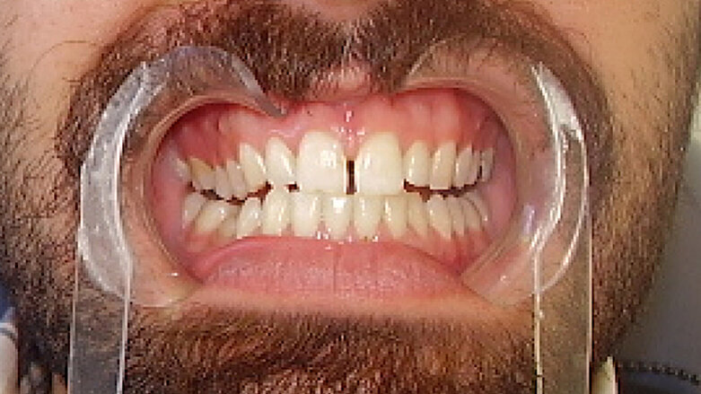 Cierre Digital de Diastema