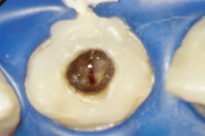 Fig. 2b: (a) Endodontically treated tooth with fistula. (b) After retreatment, the tooth showed an open apex. (c) MTA application with the MAP System and PD MTA White. Condensation of the MTA with pluggers (d) or paper points (e). (f) MTA plug. (g) Post-op radiograph showing the MTA plug and the reconstruction with a fibre post.