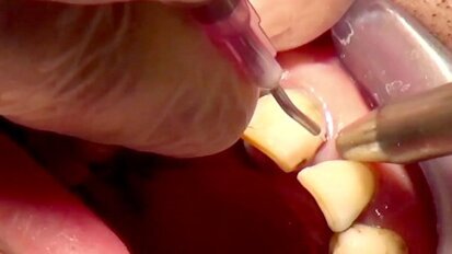 Experte erklärt photodynamische Therapiemethode