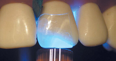 Directa CoForm matrix system provides transparent corner matrices