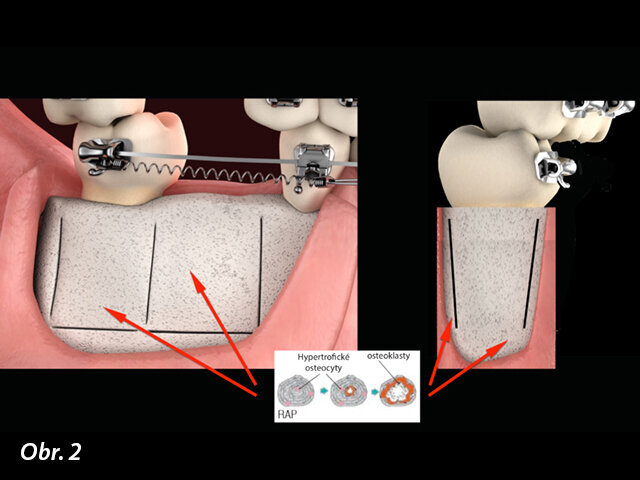 Alveolární kortikotomie