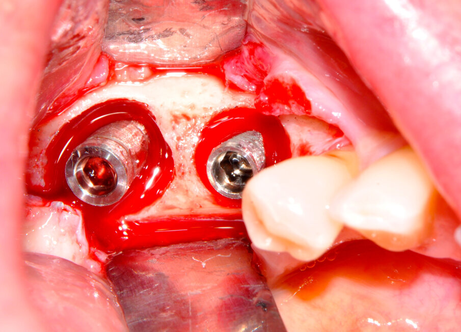 Fig. 5 – L’aspetto della superficie implantare successivo alla rimozione delle spire e a lucidatura.