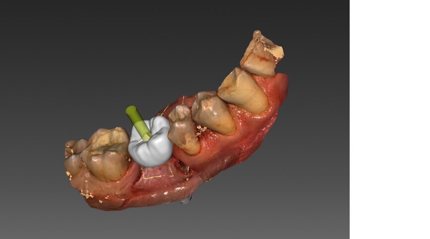 Ryc. 29-32_Projekt korony tymczasowej przykręcanej