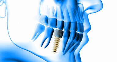 DZOI lädt zum Curriculum Implantologie 2020