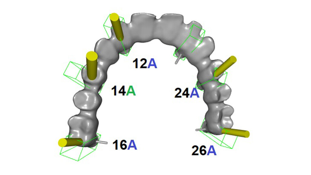 Periodontite agressiva num paciente jovem