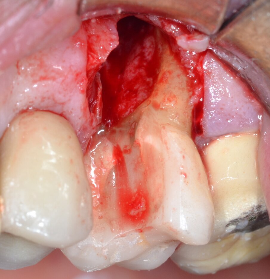Fig. 7 - L’eliminazione della radice mesio-buccale rivela lo stato dell’apparato di attacco residuo.