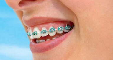 Popularne klocki pomocne w promowaniu aparatów ortodontycznych